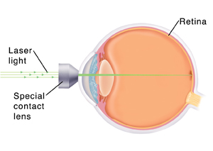 Side view of eye showing lens on front of eye. Laser light is focusing on inside back wall of eye.