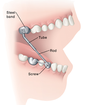 Side view of teeth in open mouth showing Herbst appliance attached to lower and upper teeth.