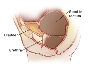 Side view of cross section of child's pelvis showing bladder, urethra, and rectum behind bladder. Rectum bulges forward into bladder because large amount of stool is in rectum. Bladder is full of urine.