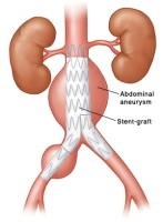 Stent graft repair of abdominal aneurysm