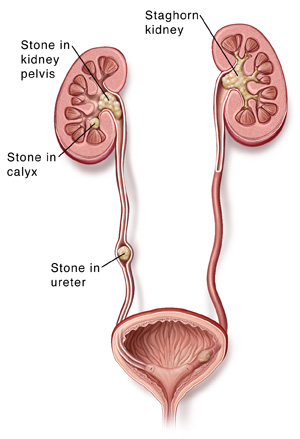 Cross section of urinary tract showing kidney stones. Stones form in kidney calyx. Staghorn stones often caused by infection. May grow until they fill up entire kidney. Some stones move to kidney pelvis, blocking urine flow. Stones often lodge in ureter. This irritates tissue, blocks urine flow, and can make urine bloody.