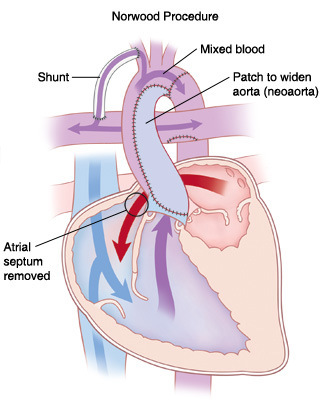 Front view cross section of heart showing Norwood procedure. Patch widens aorta (neoaorta), atrial septum is removed, and shunt goes from artery branching from aorta to pulmonary artery. Arrows show blood flowing from left atrium to right ventricle and mixed blood going from right ventricle to aorta. Some blood from aorta goes through shunt to pulmonary artery.
