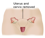 Front view of female pelvis showing reproductive organs. A dotted line outlining uterus and cervix shows total hysterectomy.