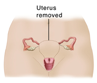 Front view of female pelvis showing reproductive organs. Dotted line around uterus shows subtotal hysterectomy.