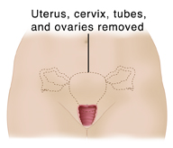 Front view of female pelvis showing reproductive organs and dotted line outlining uterus, cervix , fallopian tubes, and ovaries to show total hysterectomy and salpingo-oophorectomy.
