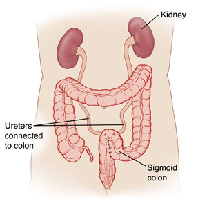 Front view of torso showing kidneys connected to sigmoid colon by ureters.