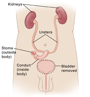 Front view of male torso showing kidneys connected to conduit and stoma by ureters. Bladder is removed.