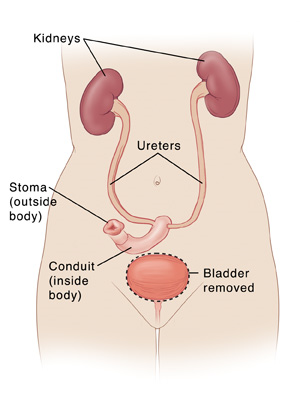 Front view of female torso showing kidneys connected to conduit and stoma by ureters. Bladder is removed.