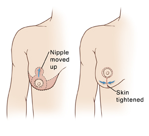 Two images of female chest showing right breast, comparing breast position before and after mastopexy, incision sites, and area of tissue removed.