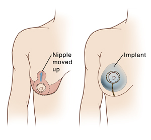 Two images of female chest showing right arm and breast. First figure shows incisions and tissue removed for mastopexy; second figure shows breast implant in place.