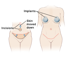 Two images of female abdomen: First image shows incisions and tissue removed for abdominoplasty. Second image shows final result of abdominoplasty plus breast implants.