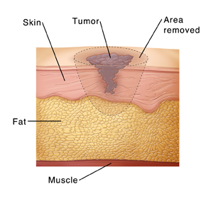 Skin layers with melanoma showing incision lines to remove tumor.