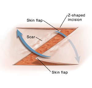 Z-plasty skin incision with arrows to show movement of flaps.