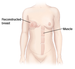 Front view of woman's chest and abdomen showing muscle from abdomen moved up to reconstruct breast.