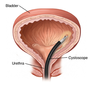 Front view cross section of bladder showing cystoscope inserted through urethra to bladder.