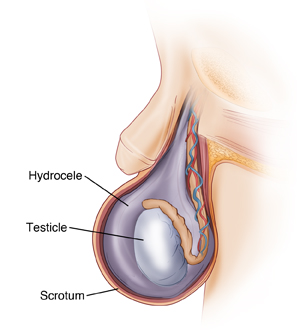 Side view of scrotum showing hydrocele formed around testicle.
