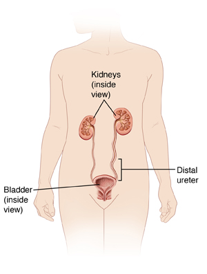 Torso of person showing kidney, bladder, inside of swollen kidney, swollen ureter, and tumor in ureter near bladder.