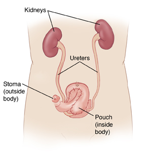 Front view of male torso showing kidneys connected to pouch and stoma by ureters.