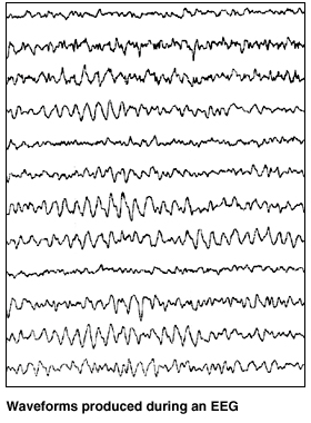 Twelve parallel lines showing normal EEG waveforms. Lines are regular, repeating pattern of small peaks and valleys.