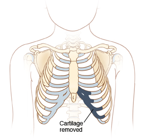 Front view of male torso and skeletal ribcage showing the location of rib cartilage removed for ear reconstruction.