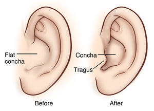 Side view of the ear before and after the reconstruction of the concha and tragus.