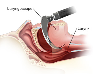 Side view of the head showing laryngoscope inserted into mouth and pharynx.