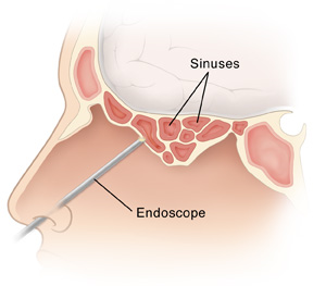 Side view of the head showing inflamed sinuses and endoscope entering through the nose.