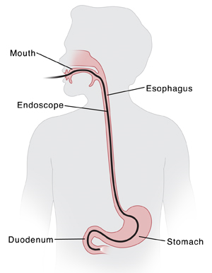 Outline of head and torso with endoscope in mouth and esophagus. Scope ends in first part of small intestine.