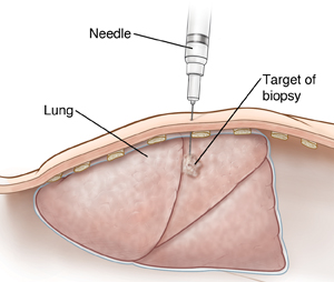 Cross section of chest showing needle collecting sample from abnormal area in lung.