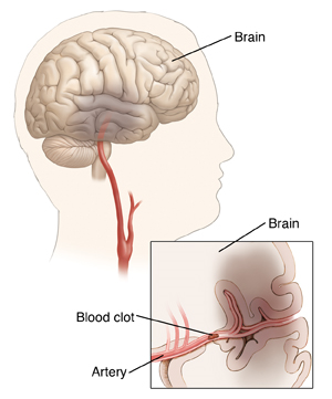Side view of head and neck showing brain with damage. Inset shows blood clot lodged in brain artery.