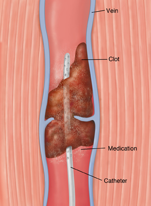 Cross section of vein with blood clot showing catheter releasing medicine into clot.