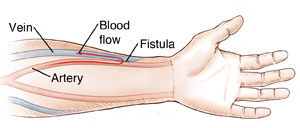 Forearm and hand showing vein and artery connected by stitches. Arrow shows blood flow going from artery to vein.