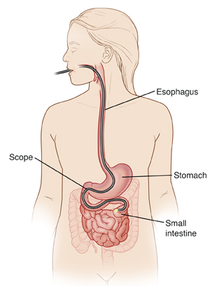 Outline of head and torso showing scope in mouth, esophagus, stomach, and past duodenum into small intestine.