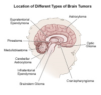 Locations of different tumors in the brain