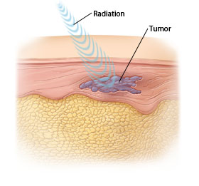 Cross section of skin showing high-dose radiation waves directed at tumor.