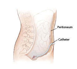View of a torso showing a catheter entering the body through the abdomen.