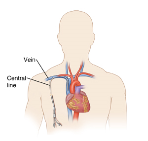 Upper torso of a person, showing the heart and large blood vessels leading to and from the heart. A catheter is shown going into a vein near the collar bone.