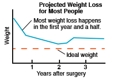 Projected weight loss for most people, showing Weight, Ideal weight, Years after surgery. Most weight loss happens in the first year and a half.