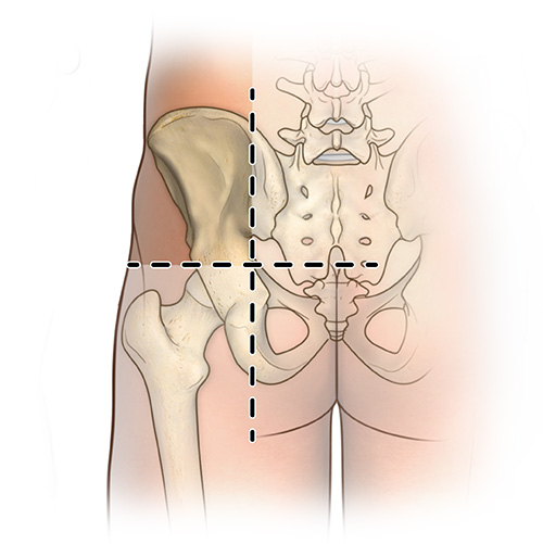 Outline of lower back, buttocks, and legs with hip bones showing. Dotted line around upper left quadrant of area highlights injection zone. 