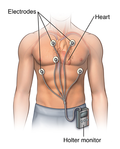 Man's chest showing the heart. Electrodes are positioned on the skin and connected to a Holter monitor on the waistband of his pants.