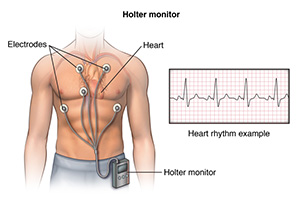 A male torso with leads attached to the chest. The leads are connected to a Holter monitor clipped to the waistband of his pants.