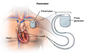Illustration of a pacemaker device and its location in the chest