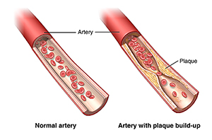 View of a normal artery and an artery with plaque buildup