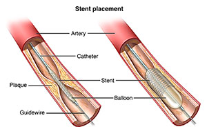 Part of an artery showing plaque build up. A catheter and stent are in place.