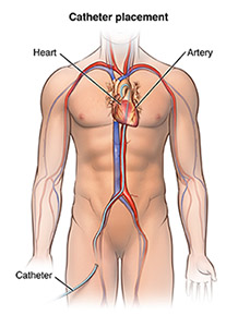 Man's torso showing blood vessels and catheter.