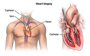 View of man's chest and a close-up image of the heart showing position of catheter.