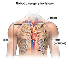 View of a man's chest with lines indicating robotic incision points.