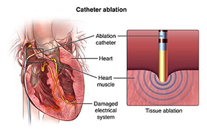 View of the electrical system of the heart and catheter in place. Close up of catheter performing tissue ablation.