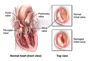Illustration of a prolapsed mitral valve