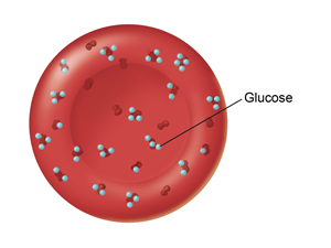 Red blood cell with too much glucose stuck to it.
